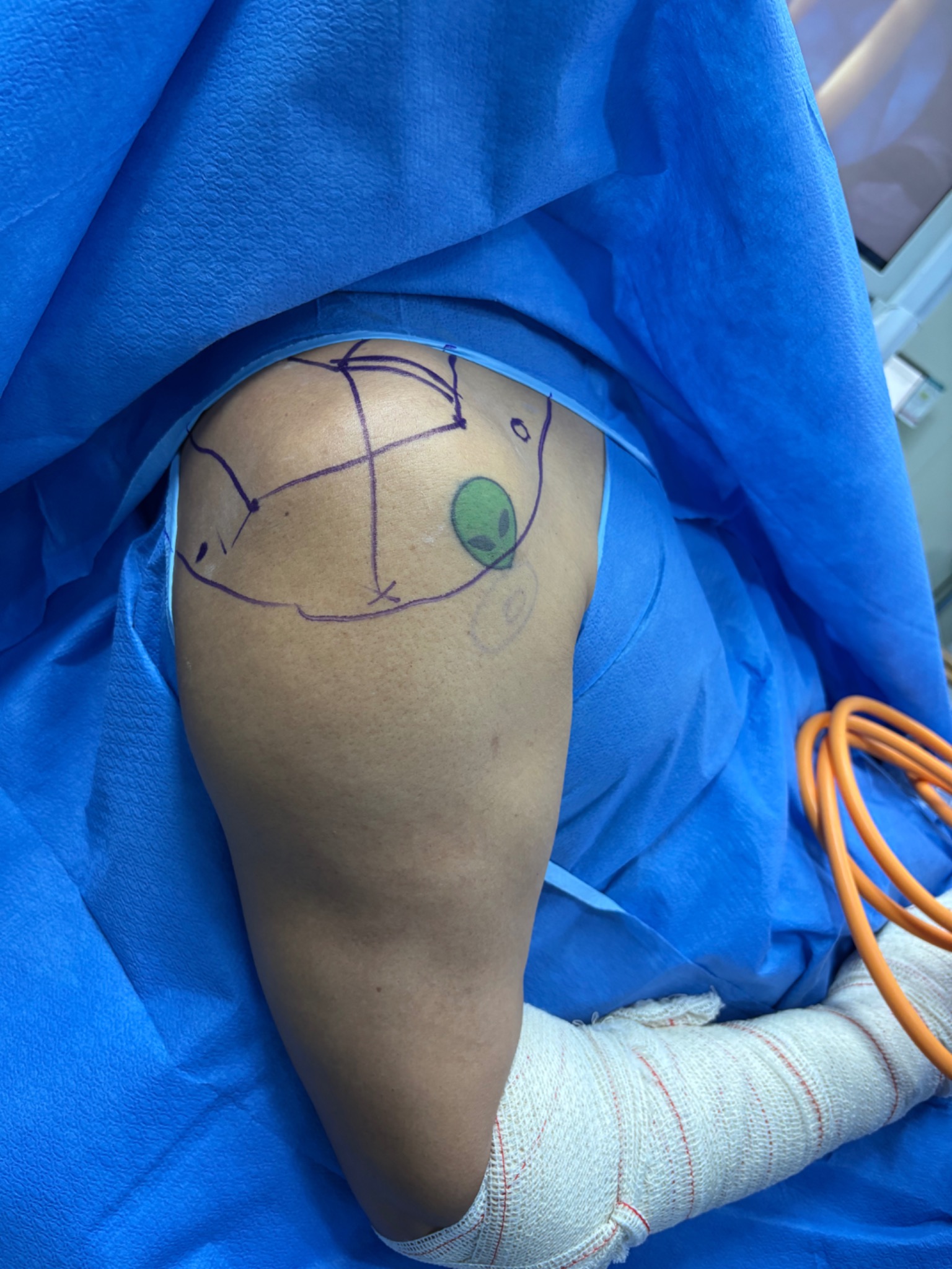 Marcação pré-operatória do ombro de paciente coberto por campos cirúrgicos, sem identificação facial.